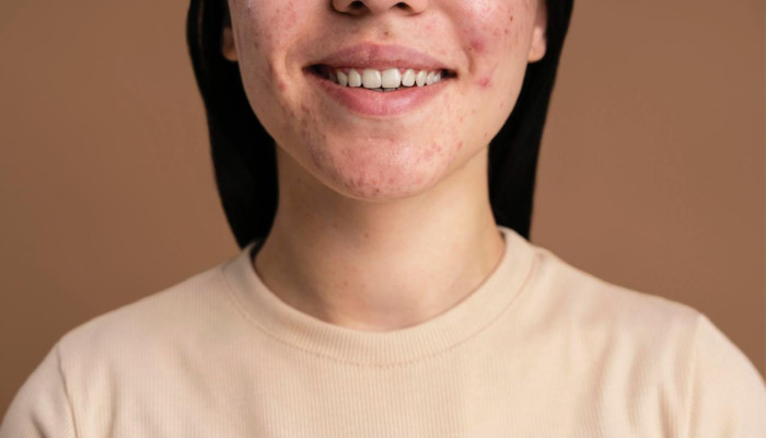 Dermatitis Perioral: Bahaya Krim Racikan Yang Mengandung Steroid