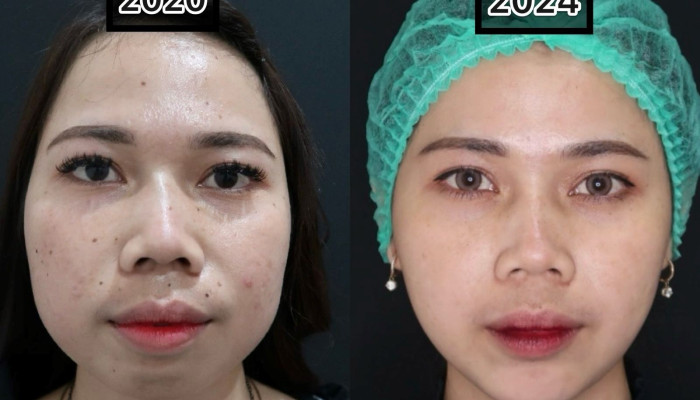 Hasil Estetika Ditentukan Oleh Injector: Mengapa Memilih Yang Tepat Sangat Penting