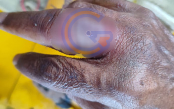 Jari Warga Terjepit Cincin, Tim Rescue BPBD Sidoarjo Lakukan Evakuasi Aman 2 20260804 075751 1